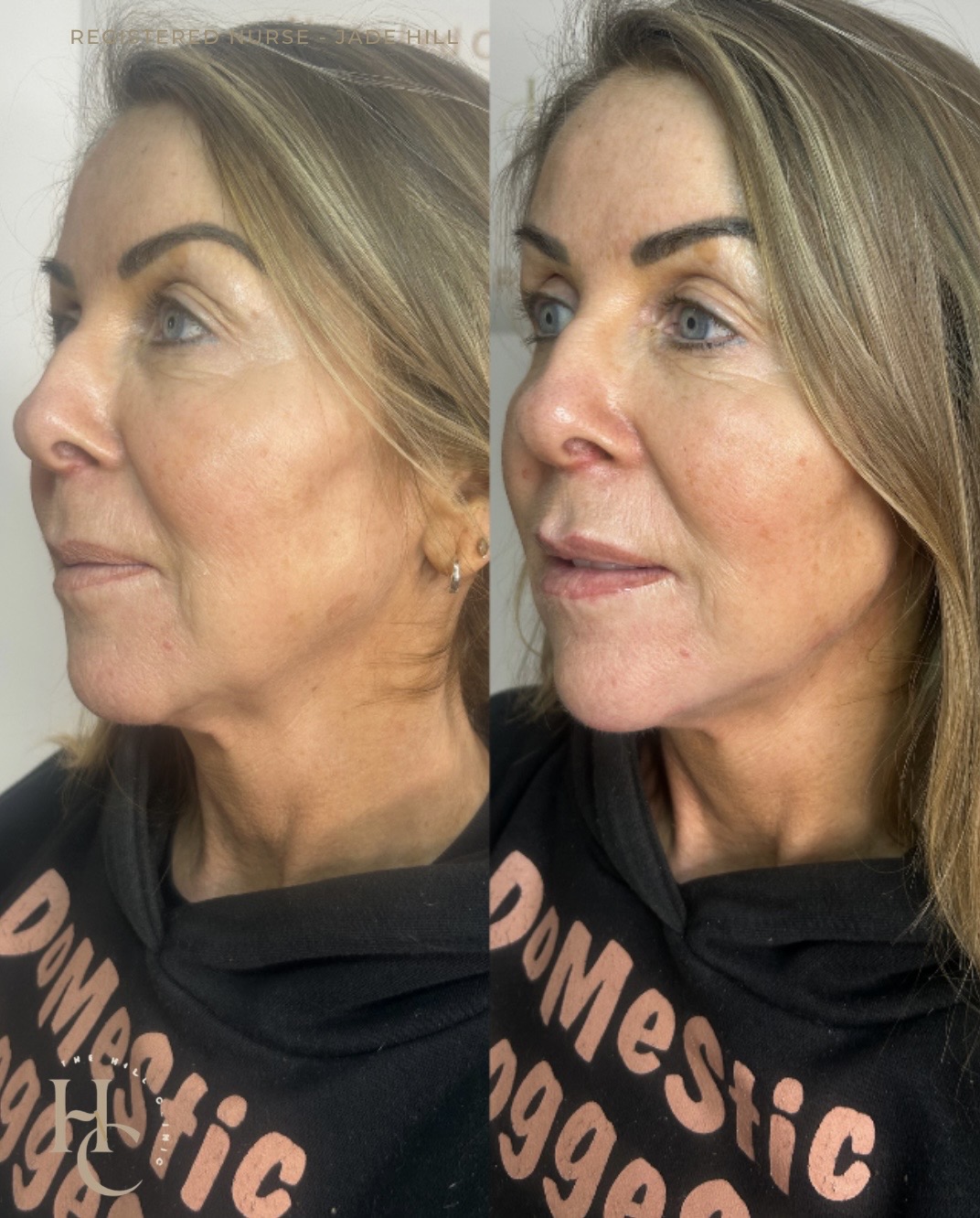 Lower Face Rejuvenation 