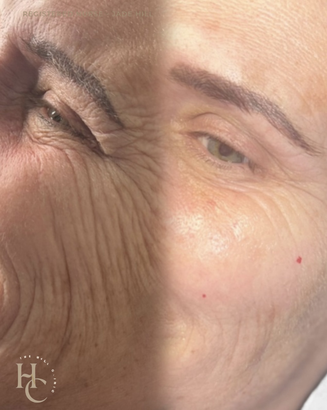 Skin Booster Results 