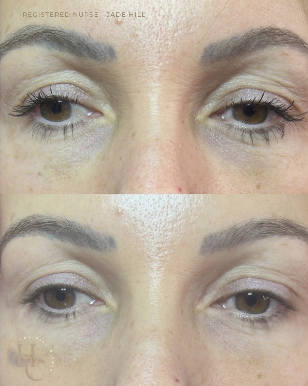 Undereye Polynucleotide (One Treatment) 