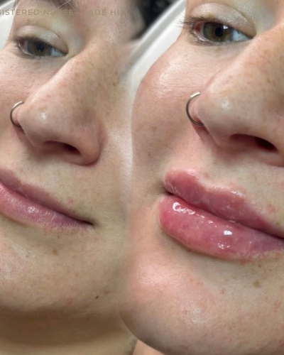 Lip Enhancement