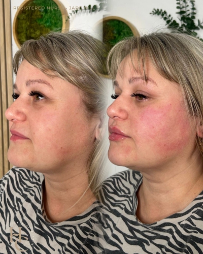 Bio stimulating Filler and Lip Enhancement