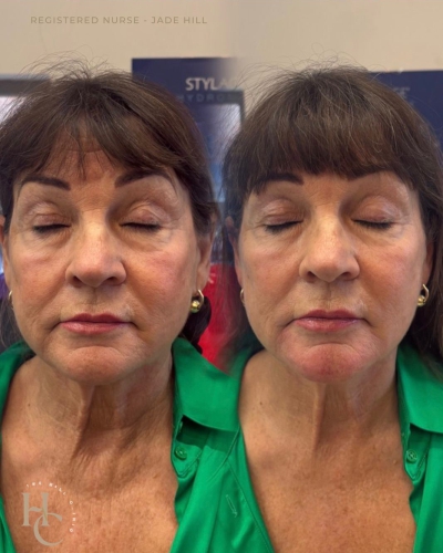 Bio Stimulating Filler