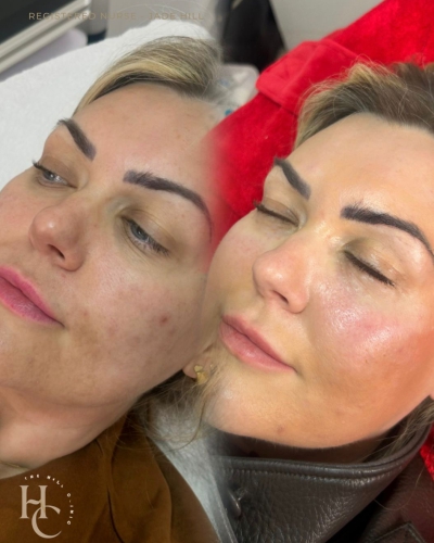 Under Eye Polynucleotides and Skin Boosters