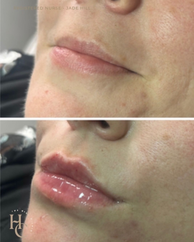 Lip Enhancement